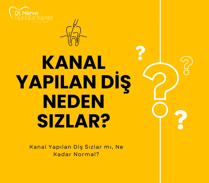 Kanal yapılan diş neden sızlar infografik