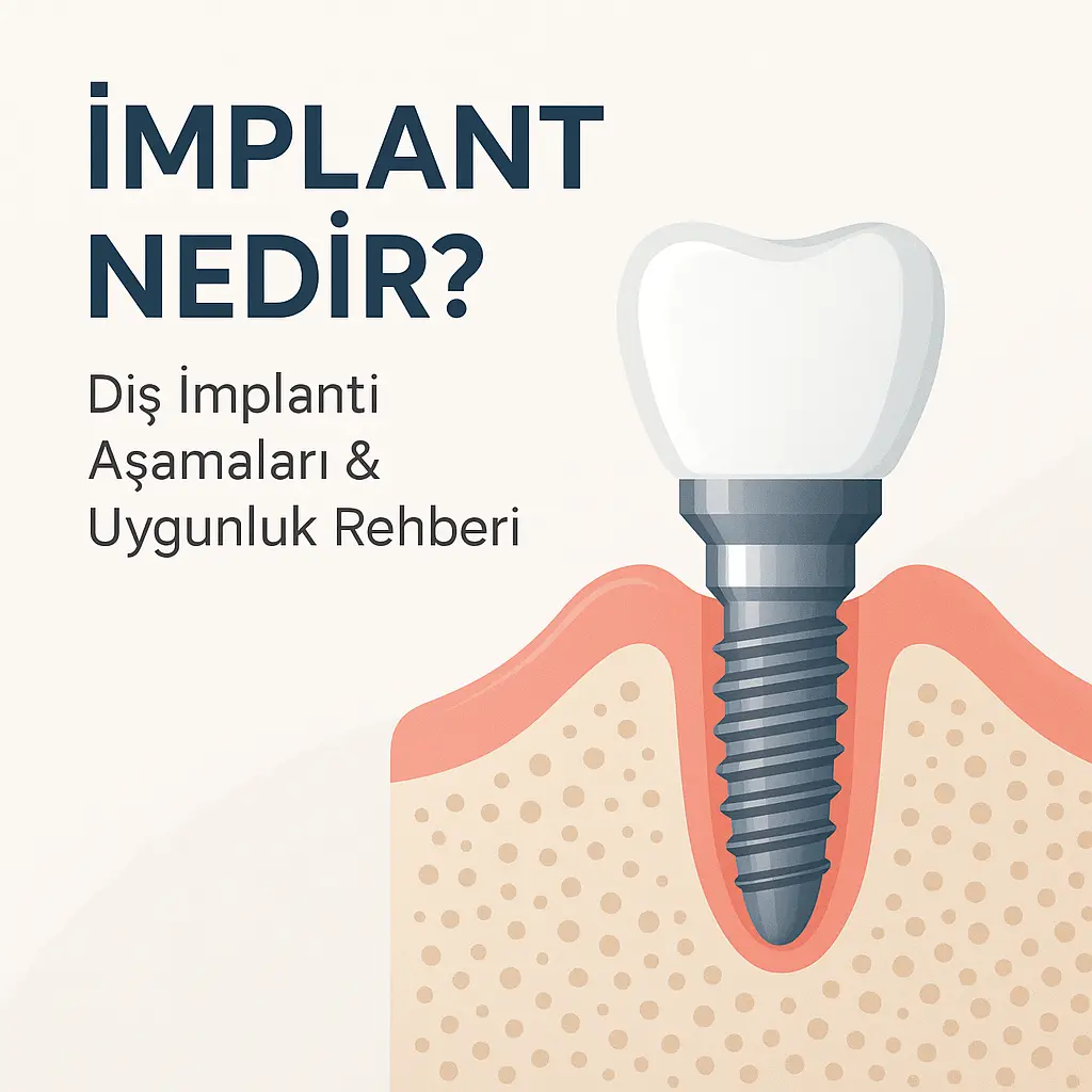 Diş implantı nedir ve nasıl yapılır – implant tedavisi görseli