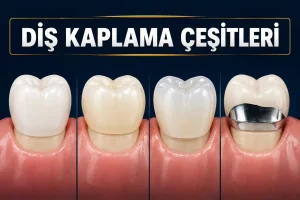 en çok tercih edilen diş kaplama çeşitlerini gösteren görsel